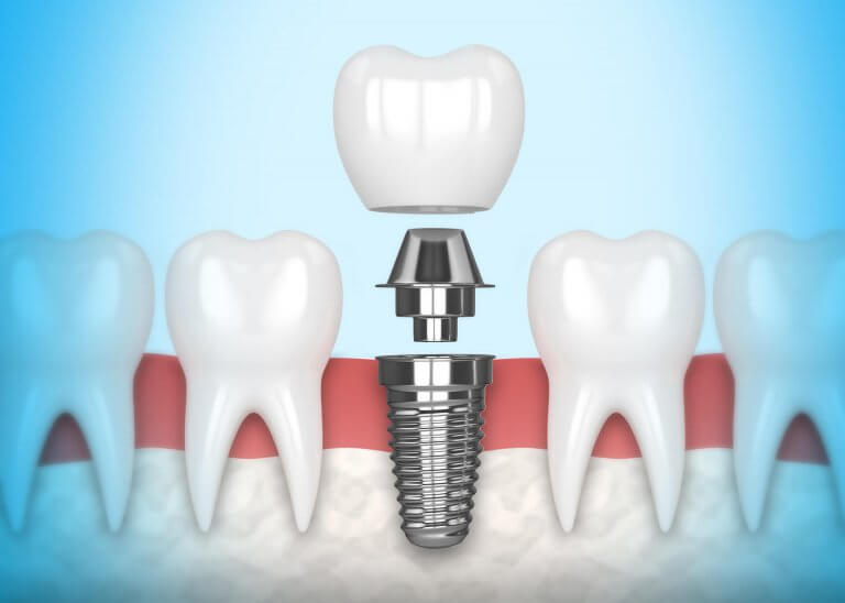 Fogászati implantátumok ára