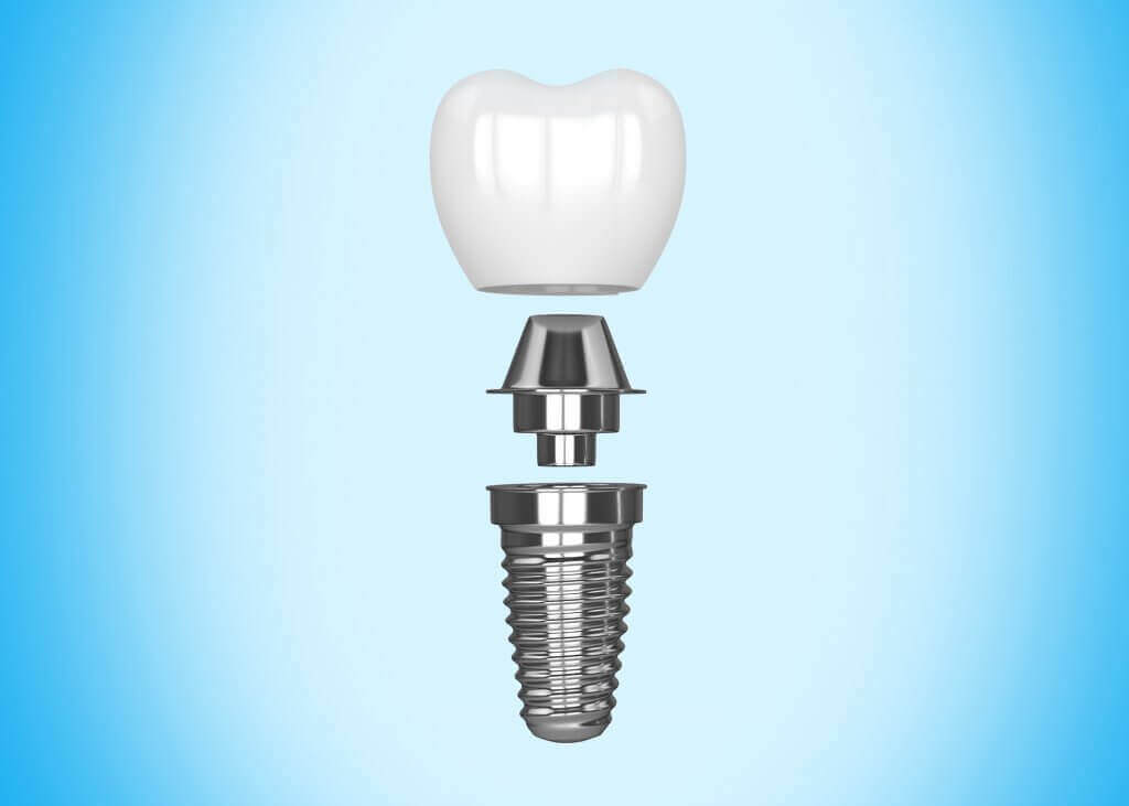 fogászati implantátumok