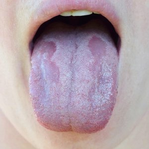 paraziták a szájban a nyelven
