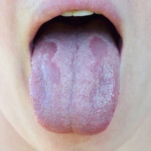 candida nyelven kezelés szemölcsök a szemben