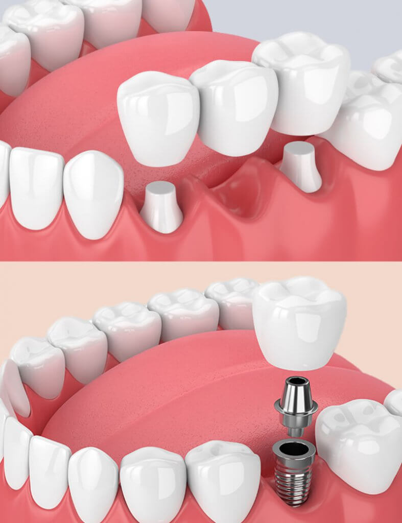 fogaszati implantatumok