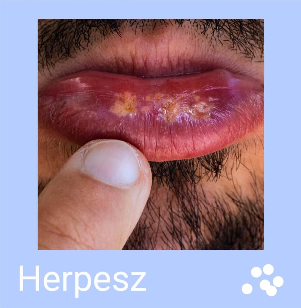 herpesz