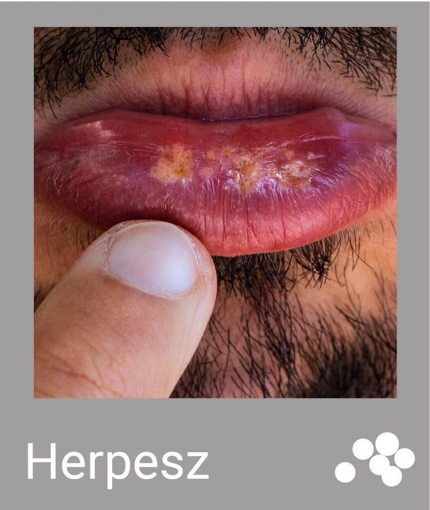 herpesz