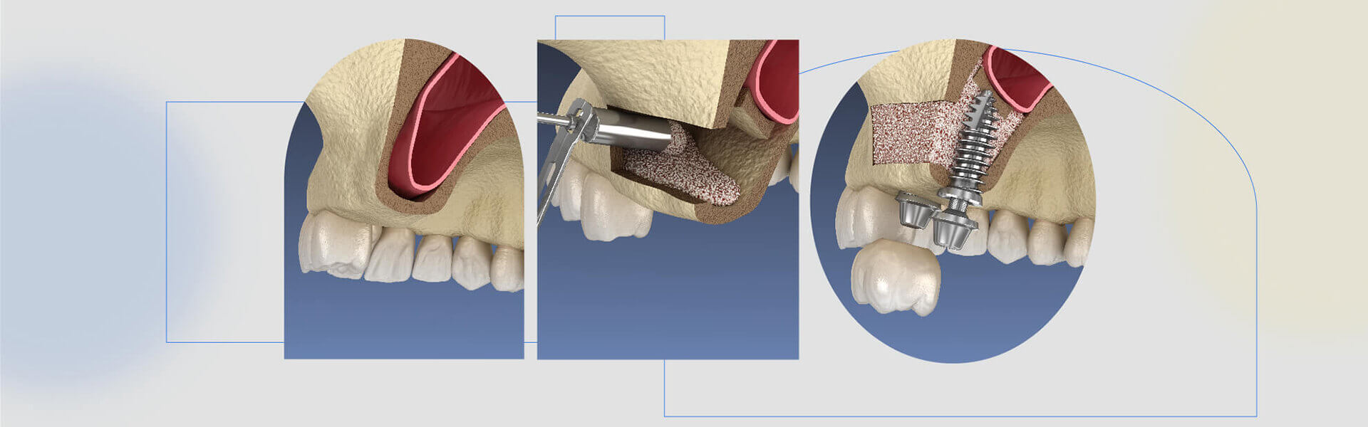 sinus lift