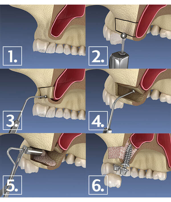 sinus lift