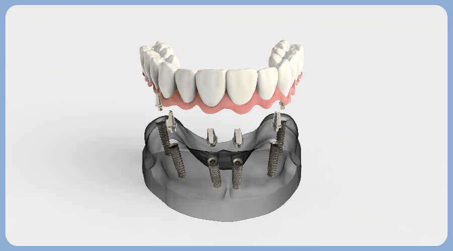 fogaszati implantatum